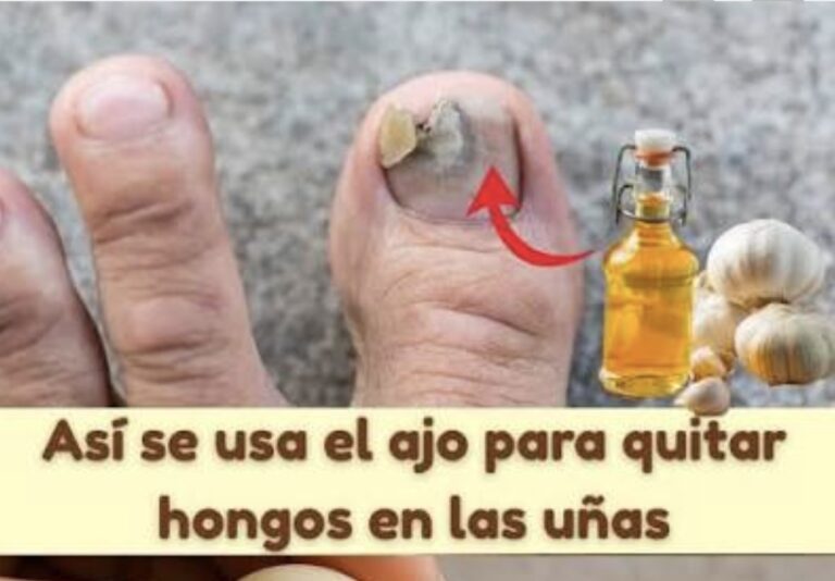Ajo y aceite natural para las uñas de los pies