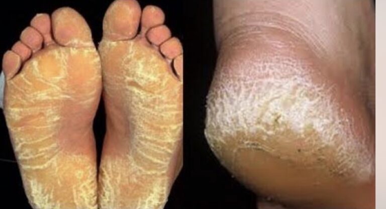 Callos en los pies: vaselina, aceite Johnson y limón