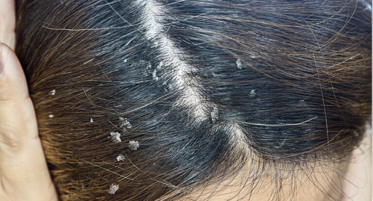 Caspa en el cabello: remedio natural con neem y vinagre de manzana para un cuero cabelludo equilibrado