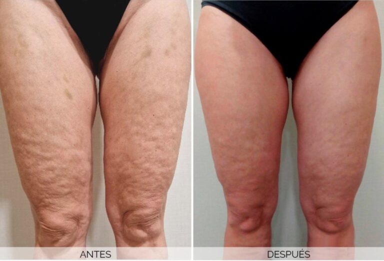 Celulitis en las piernas y glúteos: remedios naturales que pueden ayudar a mejorar su apariencia