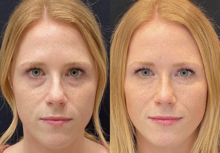 Ojeras profundas: cómo mejorar la apariencia de una mirada cansada y recuperar un aspecto fresco y luminoso