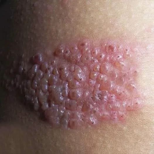 Así es el herpes zóster: la enfermedad silenciosa que puede aparecer cuando menos lo esperas